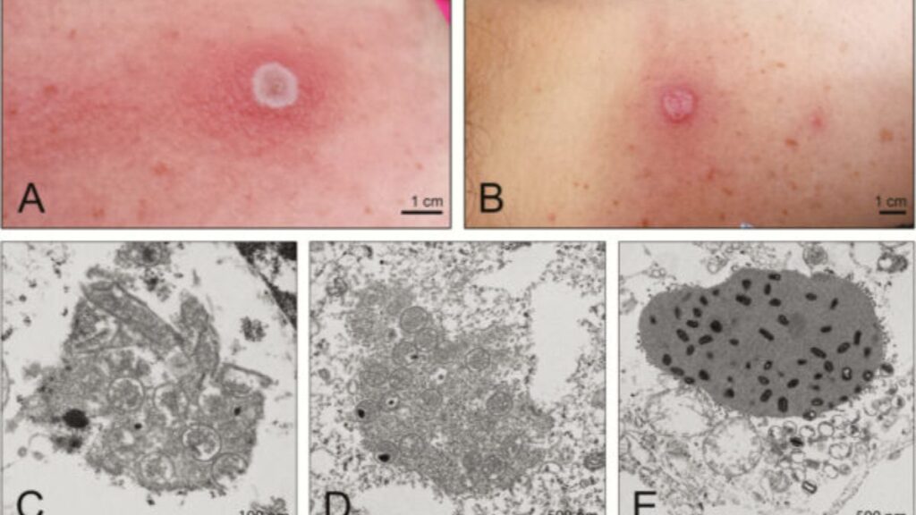 Alaskapox Virus disease क्या है ?