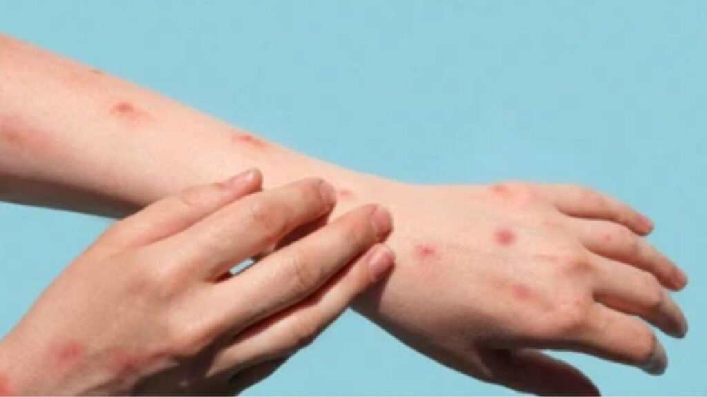 Alaskapox Virus के क्या लक्षण हैं?